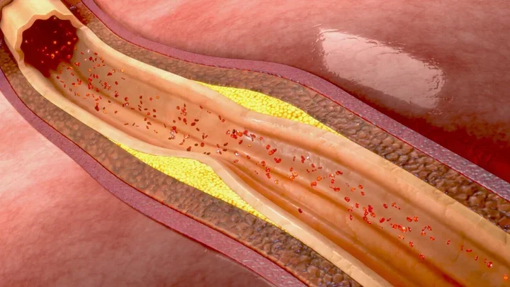 Artery wall with early plaque formation.
