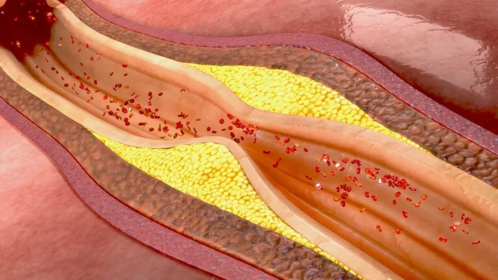 Artery wall with significant plaque formation.