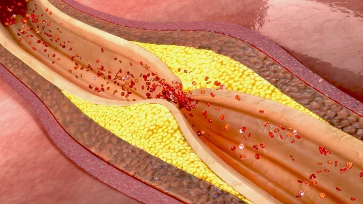 Artery wall with severe plaque formation and rupture.