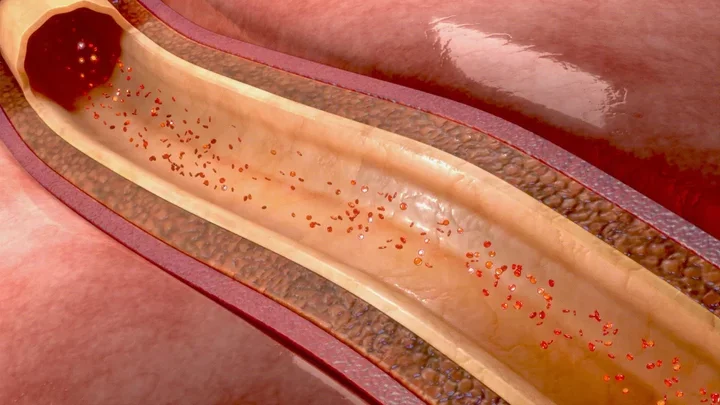 Clear artery wall.